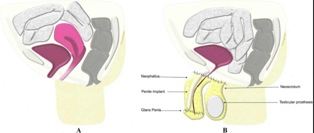 gender reassignment surgery regret reddit