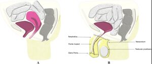 Gender reassignment surgery before and after photos Reddit