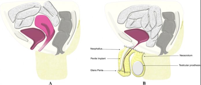 what is dilation after gender reassignment surgery