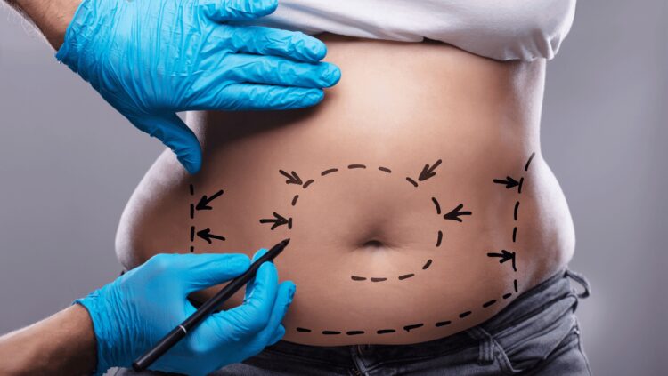 What Type of Liposuction Removes the Most Fat?