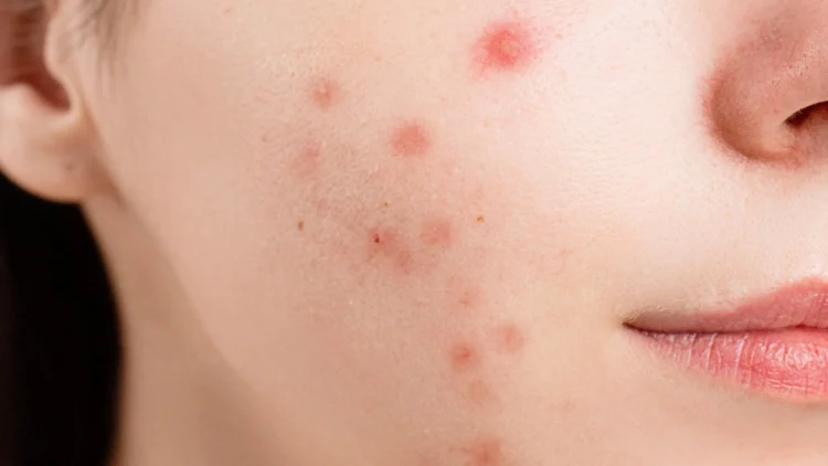 14 Do's And Don'ts For Treating Acne-Prone Skin