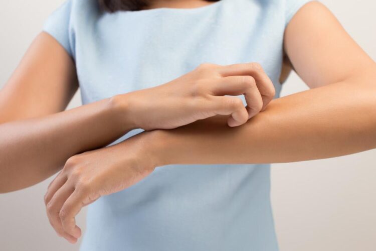 How To Keep Control of Eczema Breakouts - 2024 Guide