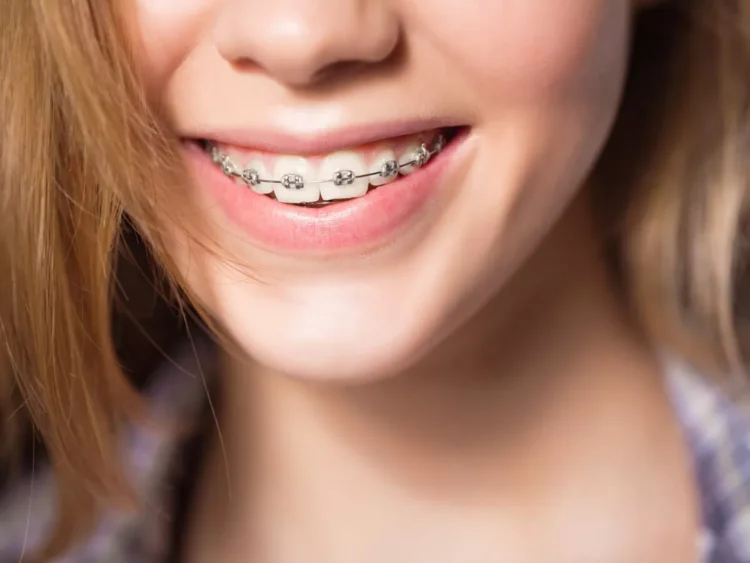 At What Age Do Braces Work The Best? 7 Things To Know