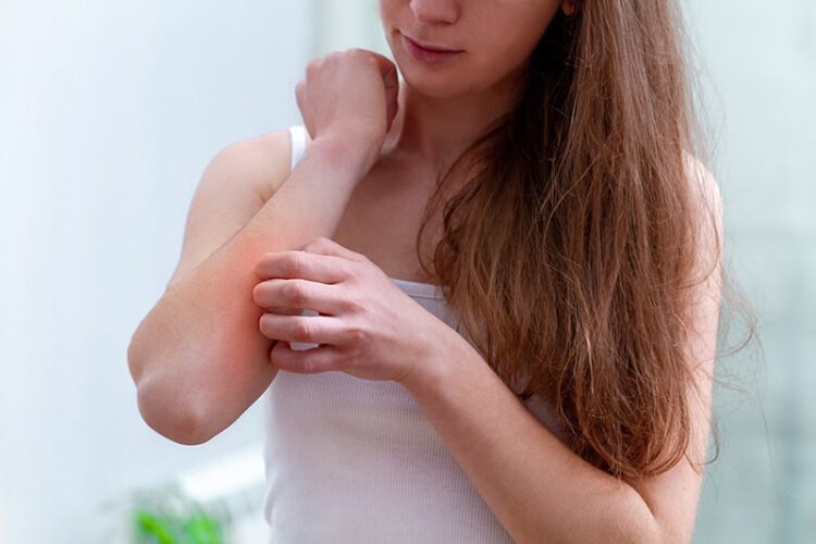 How To Keep Control of Eczema Breakouts - 2023 Guide