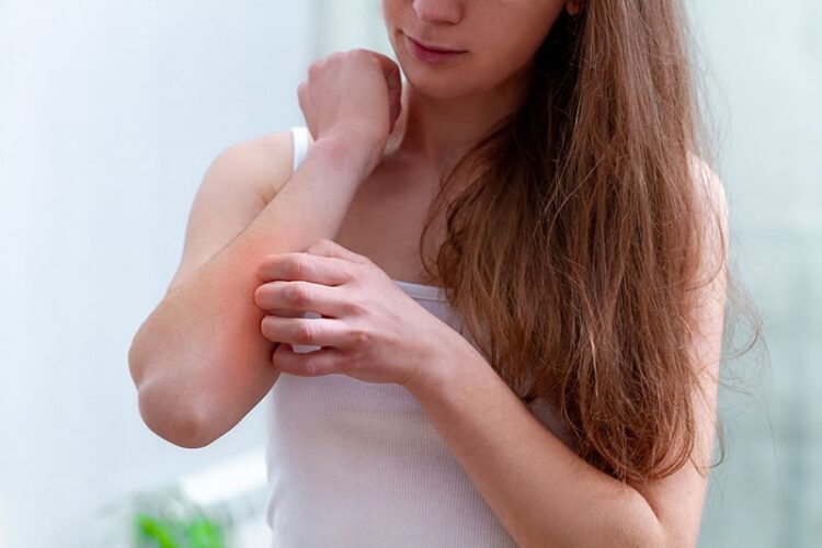 How To Keep Control of Eczema Breakouts - 2024 Guide