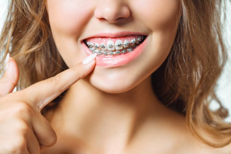 At What Age Do Braces Work The Best? 7 Things To Know