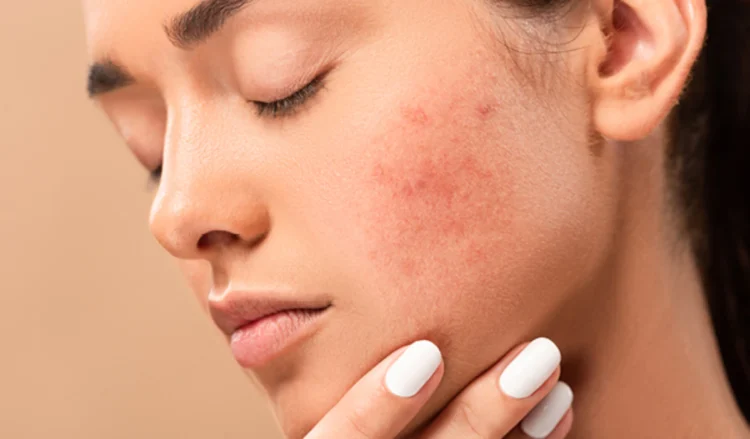 14 Do's And Don'ts For Treating Acne-Prone Skin