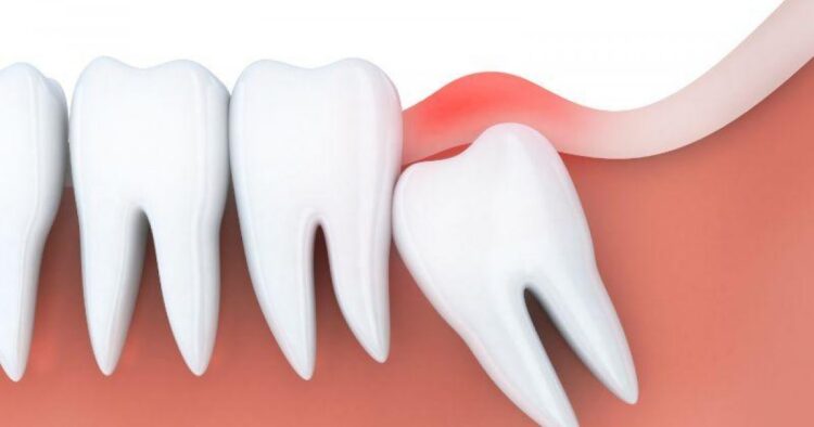 How To Know If Your Wisdom Tooth Is Infected - 2023 Guide
