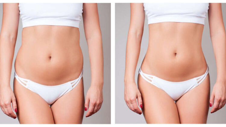 A New You: How Liposculpture in Sydney Can Transform Your Everyday Life